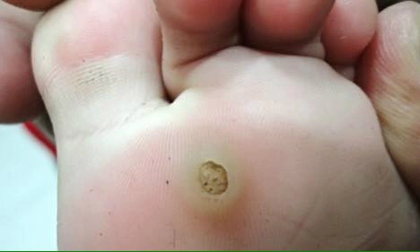 Xử trí mụn cóc - Tin tức mới nhất 24h qua - Báo VnExpress