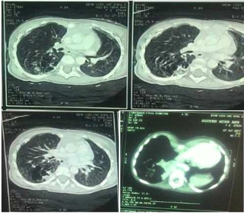 Phim CT scan ngực ghi nhận tổn thương phổi biệt trí trong thùy dưới phổi phải