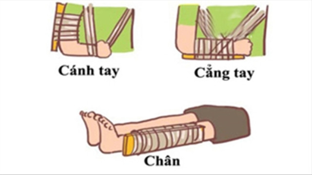 Hướng dẫn sơ cứu đúng cách cho trẻ bị gãy xương - VnExpress Sức khỏe