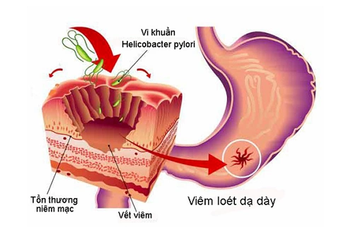 HP có thể gây viêm loét dạ dày.