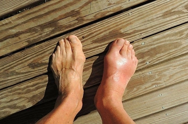 Bệnh gout là gì? - Báo VnExpress Sức khỏe