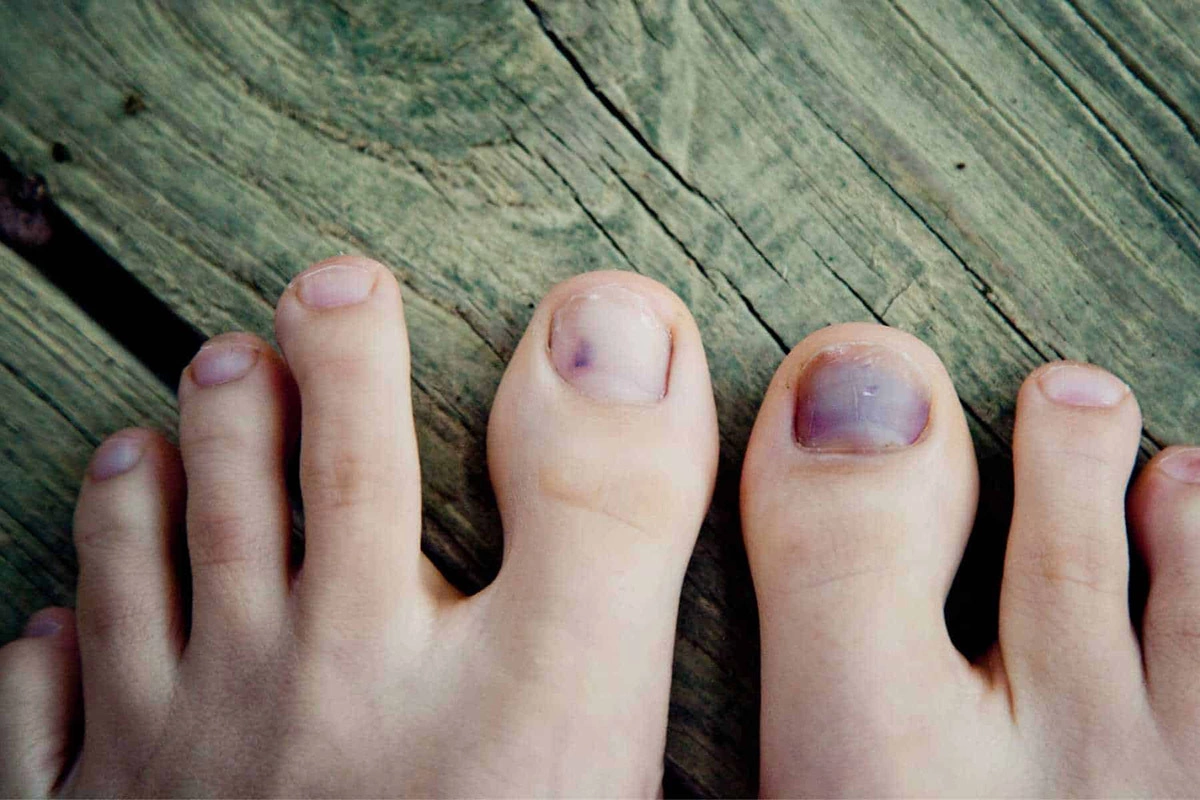 móng chân bị tụ máu