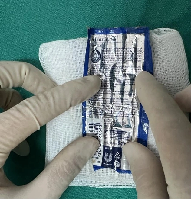 Dị vật là vỏ kem xả tóc được các bác sĩ lấy ra. Ảnh: Bệnh viện cung cấp