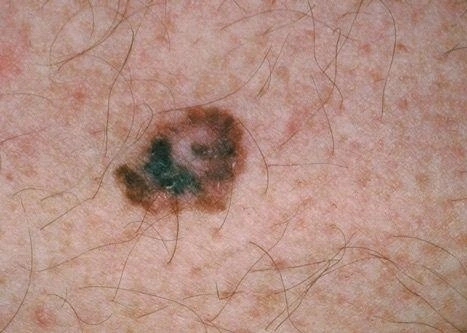 Hình ảnh màu sắc không đồng nhất của nốt ruồi. Ảnh: American Academy of Dermatology