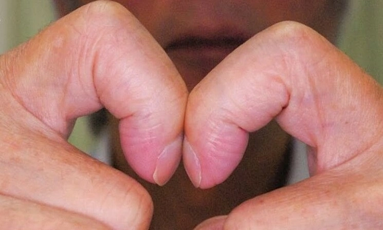 Ung thư phổi có biểu hiện trên ngón tay? - Báo VnExpress Sức khỏe