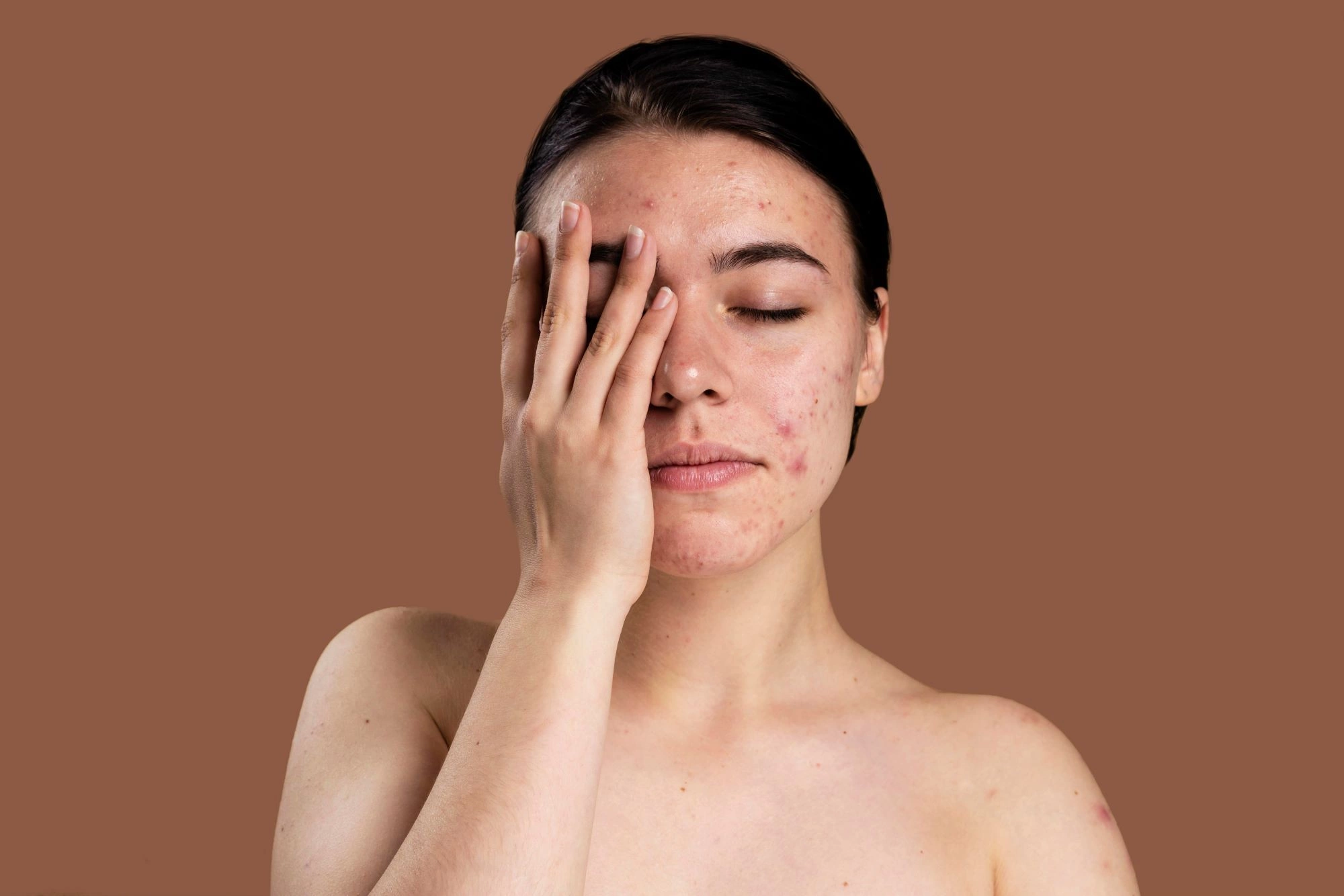Stress có thể khiến mụn có thể trở nên khó kiểm soát