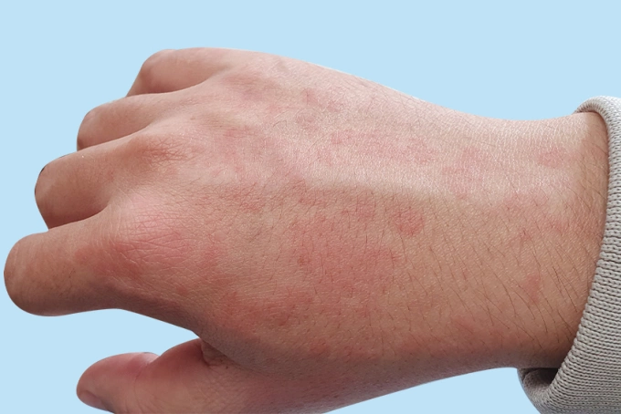 Nổi mề đay bởi dị ứng thức ăn - Báo VnExpress Sức khỏe