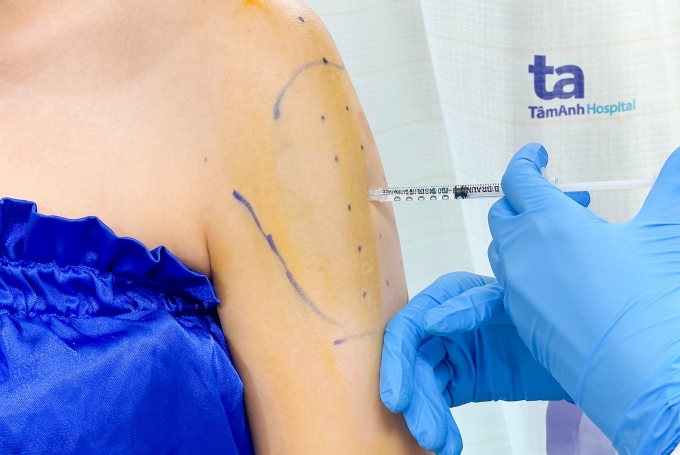 Tiêm botox thon gọn bắp tay tại Bệnh viện Đa khoa Tâm Anh TP HCM. Ảnh minh họa: Bệnh viện cung cấp