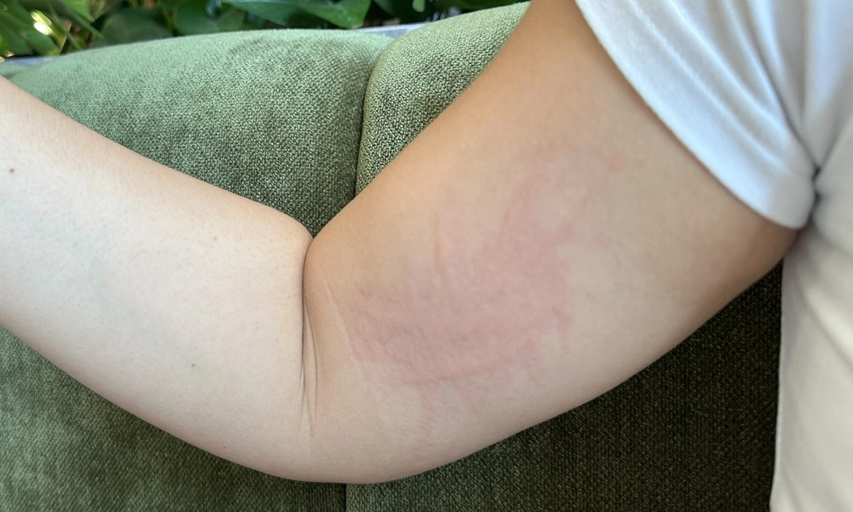 9 dấu hiệu bệnh thận trên da - Báo VnExpress Sức khỏe