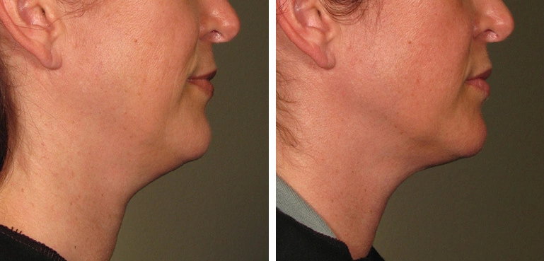 Ultherapy Prime có tốt không? Phân tích từ chuyên gia