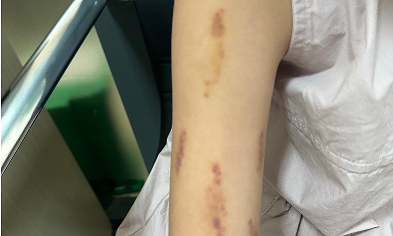 Rối loạn hành vi, bé gái tự cào cấu cơ thể