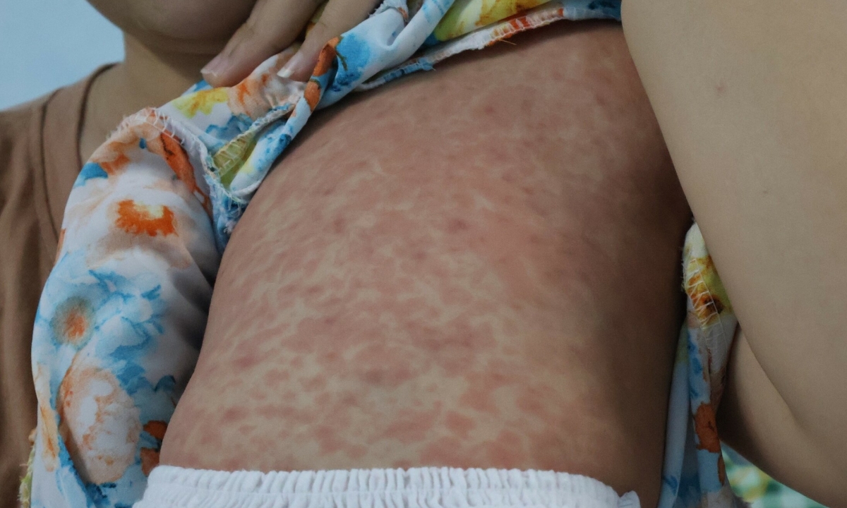 Sởi lây nhanh hơn cúm, bác sĩ khuyến cáo tiêm vaccine sớm