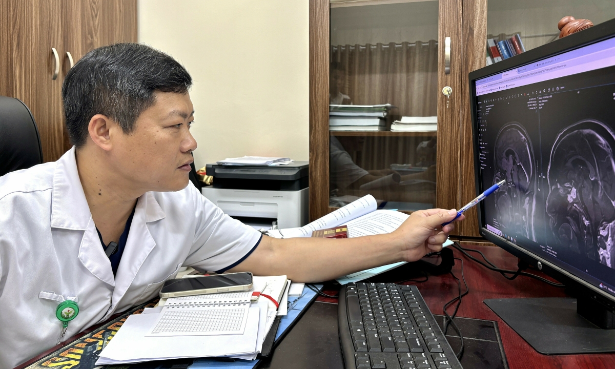 Vừa nội soi qua mũi vừa mở hộp sọ loại bỏ khối u não