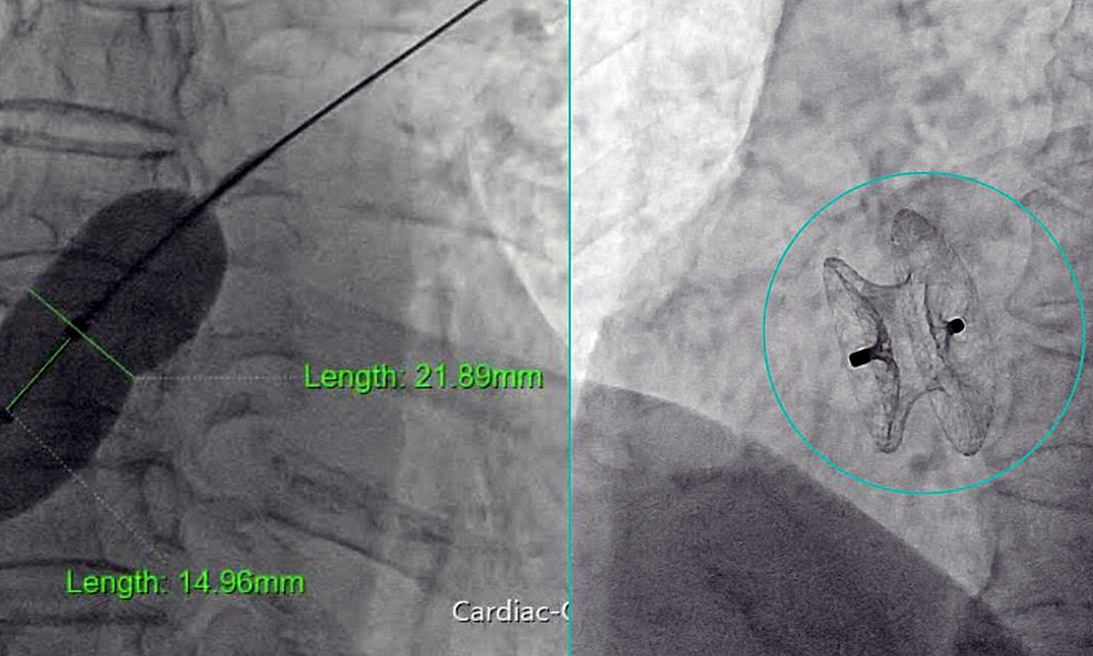 Đóng lỗ thông liên nhĩ bằng dù qua da