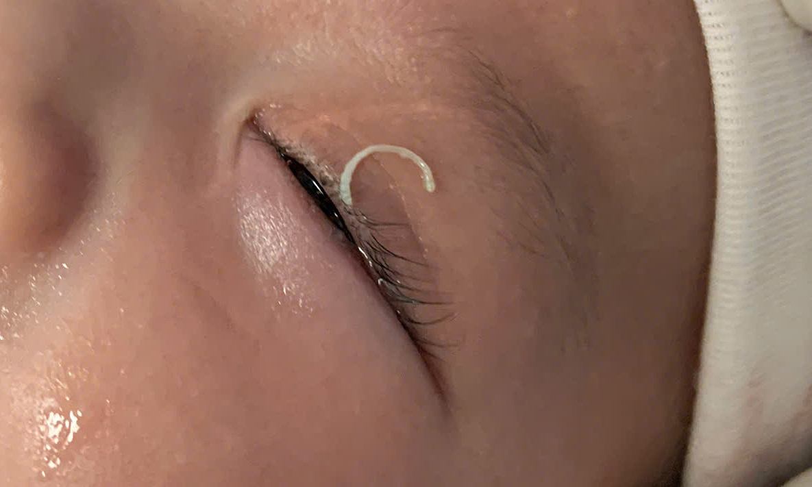 Mẹ cắt móng tay văng vào mắt con gây xuất huyết