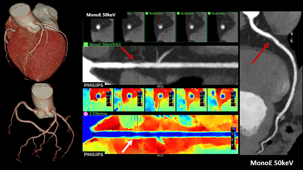 AI giúp chẩn đoán sớm bệnh tim mạch, ung thư
