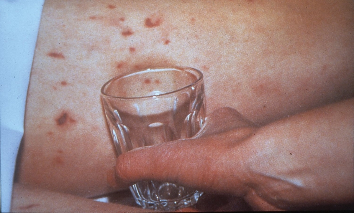 Phòng Bệnh Não Mô Cầu: Bí Quyết Sức Khỏe Từ Những Thói Quen Hàng Ngày