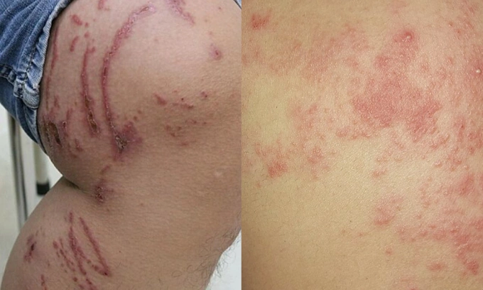 Các bóng nước của viêm da do kiến ba khoang (bên trái) và bóng nước do zona thần kinh (bên phải). Ảnh: Diệu Thuần, BV Da liễu TP HCM