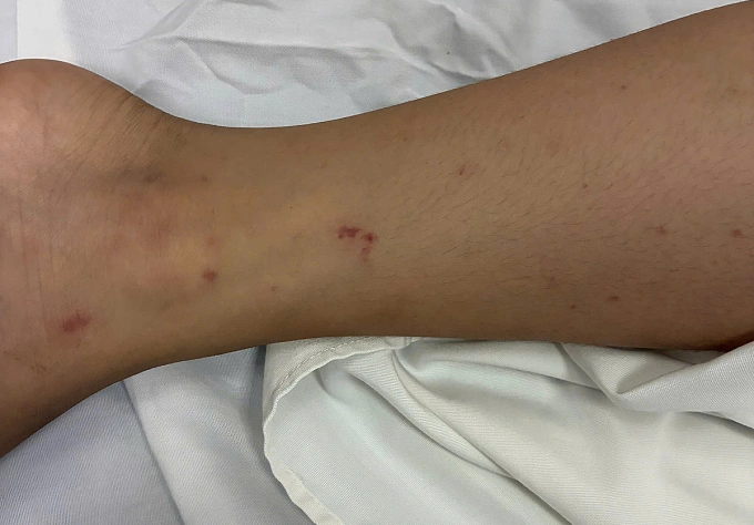 Các chấm xuất huyết trên da bệnh nhi. Ảnh: Bệnh viện cung cấp