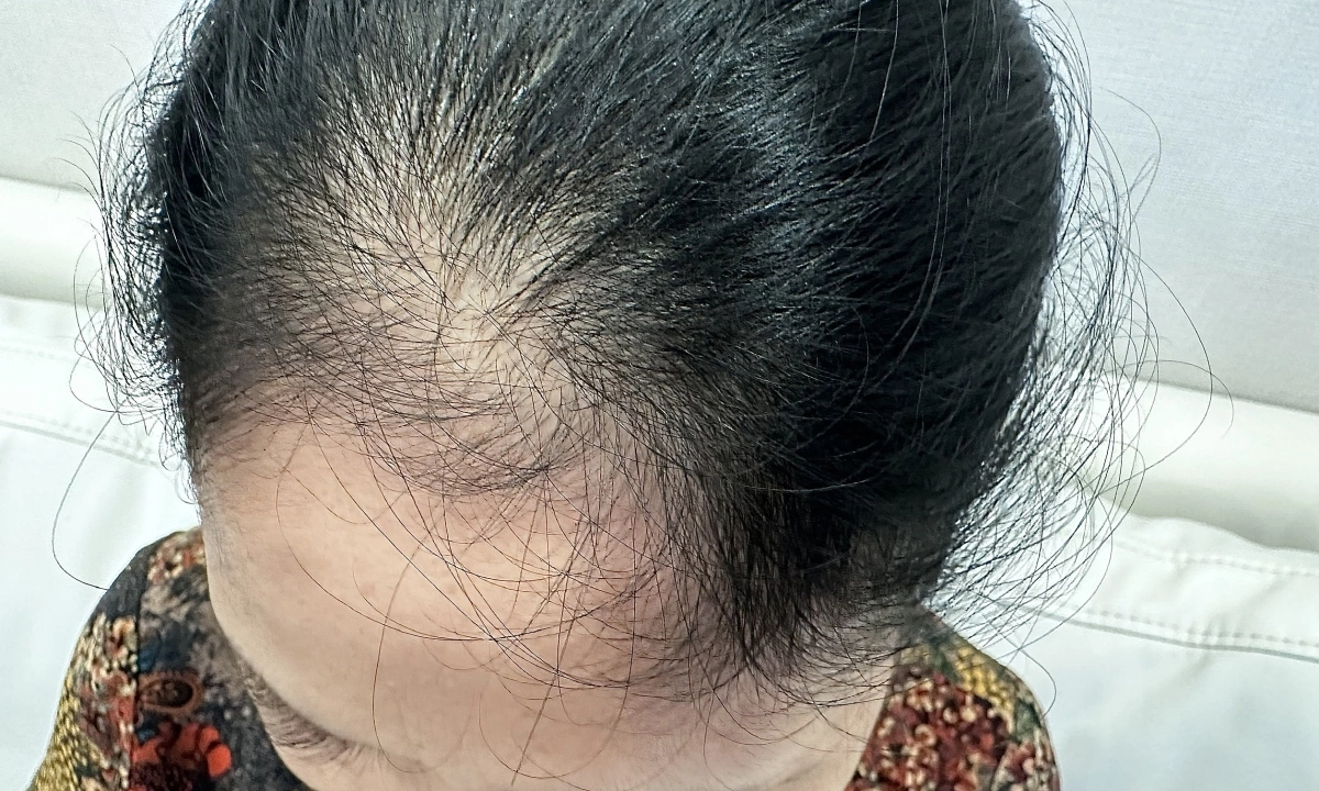 Dấu hiệu bệnh vảy nến da đầu