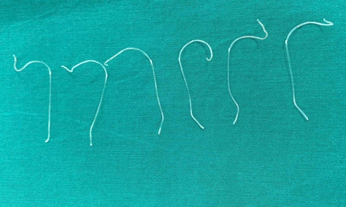 Biến chứng sau nâng mũi bằng chỉ