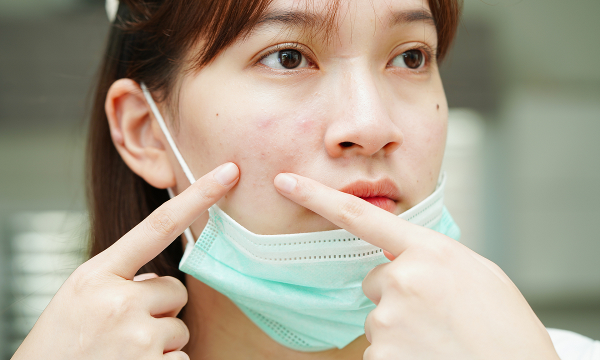 Những câu hỏi về vaccine ngừa mụn trứng cá