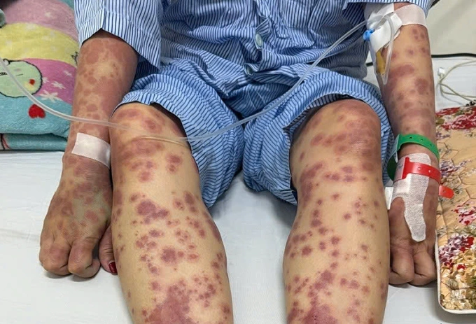 Da của bệnh nhân khi vào viện điều trị. Ảnh: Bệnh viện cung cấp