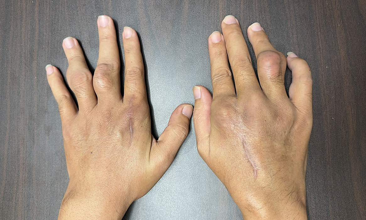 Sống chung bệnh gout từ tuổi đôi mươi