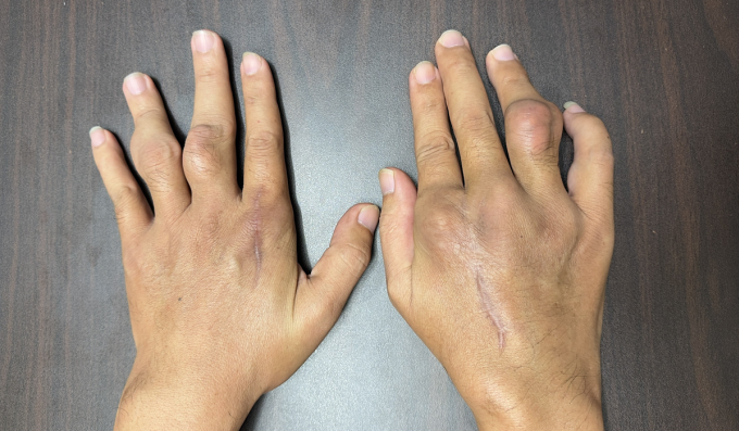 Một bệnh nhân trẻ bị biến dạng khớp do gout. Ảnh: Bác sĩ cung cấp