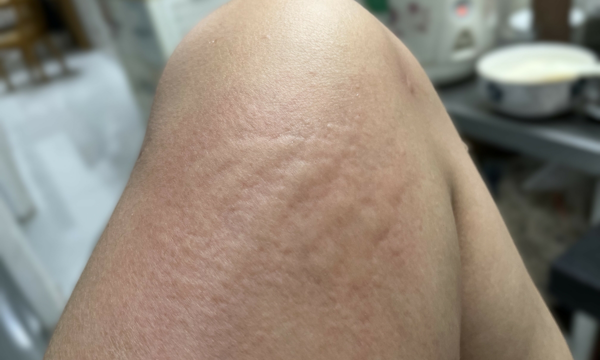 Bị dị ứng khi côn trùng đốt, có được tiêm vaccine?