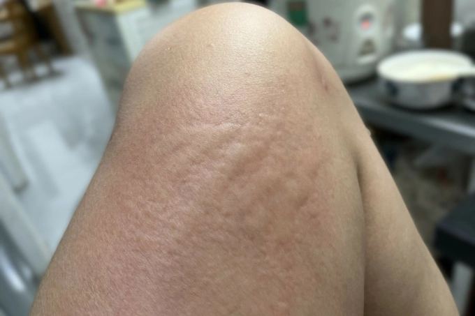 Dị ứng do côn trùng cắn, chích sẽ dần phục hồi trong vòng vài giờ hoặc vài ngày, có thể tiêm vaccine. Ảnh: NVCC