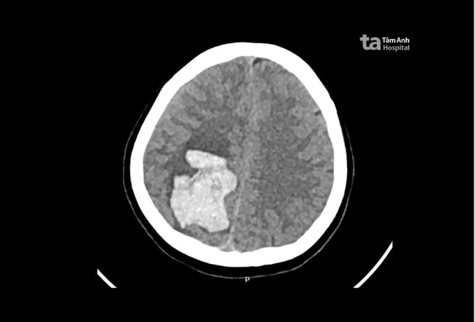 Kết quả chụp CT sọ não cho thấy ổ xuất huyết lớn trong não chị Quyên. Ảnh: Bệnh viện Đa khoa Tâm Anh