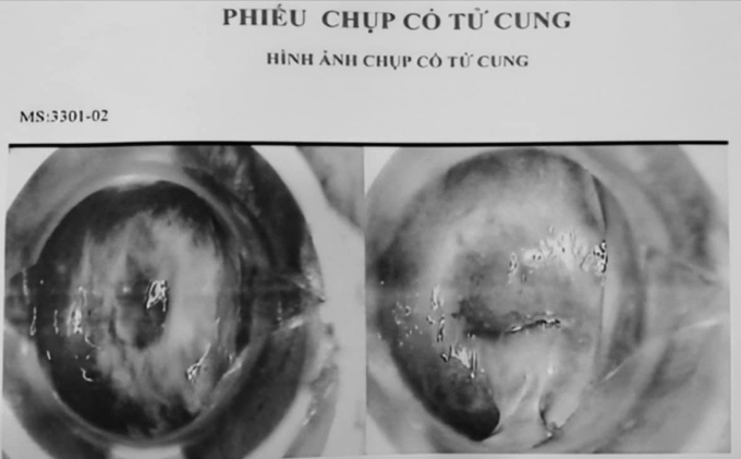 Hàng trăm hình ảnh chụp cổ tử cung bệnh lý, có mã số (ký hiệu MS) có sẵn trong máy tính của bác sĩ tại phòng khám. Ảnh: Sở Y tế TP HCM