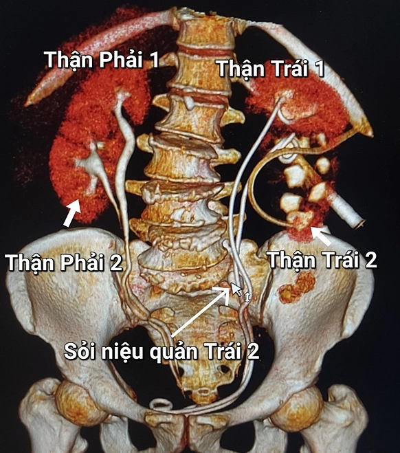 Hình ảnh trên phim chụp của người bệnh. Ảnh: Bác sĩ cung cấp
