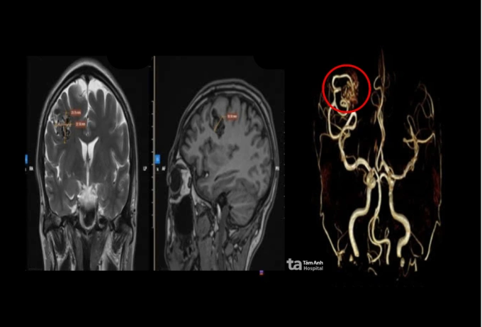 Chụp MRI 3 Tesla cho thấy búi dị dạng động - tĩnh mạch tại vùng đỉnh phải của anh Ngọc. Ảnh: Bệnh viện Đa khoa Tâm Anh