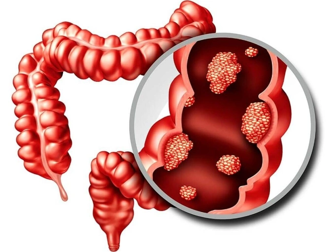 Minh họa khối u ung thư hình thành trong đại tràng. Ảnh: Booking Health