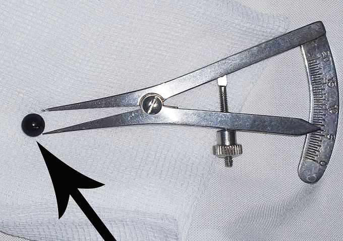 Viên đạn bi sắt 6mm ở mí mắt được bác sĩ gắp ra ngoài. Ảnh: Bệnh viện cung cấp