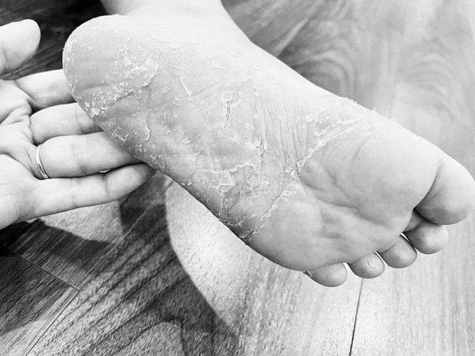 Một bệnh nhân bị viêm da. Ảnh: Bác sĩ cung cấp