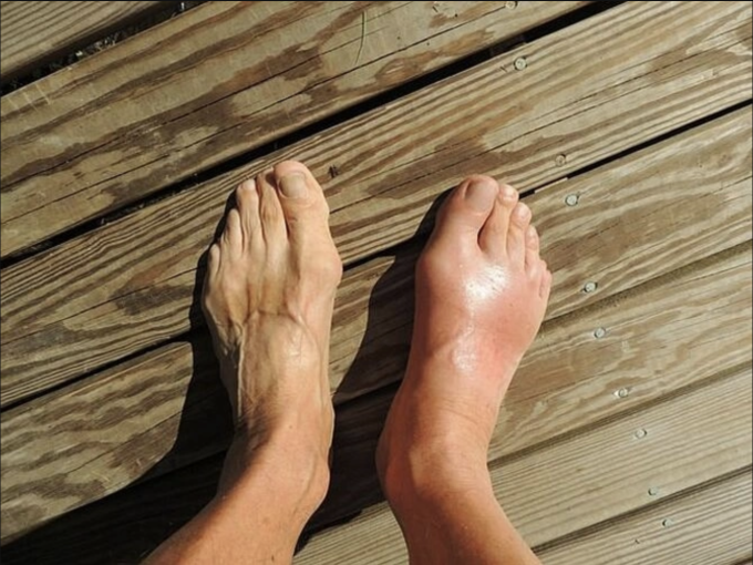 Bàn chân bị bị sưng đau do gout. Ảnh: footdoctorscolorado