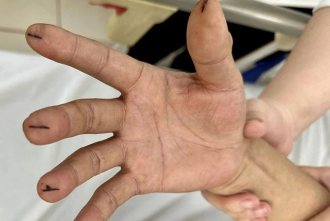 Minh họa một bệnh nhân dùng lưỡi lam cắt sâu vào 5 đầu ngón tay. Ảnh: Bác sĩ cung cấp