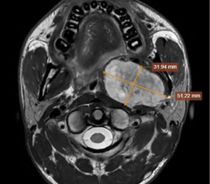 Chụp MRI cho thấy khối u kích thước lớn vùng họng. Ảnh: Bệnh viện Đa khoa Tâm Anh