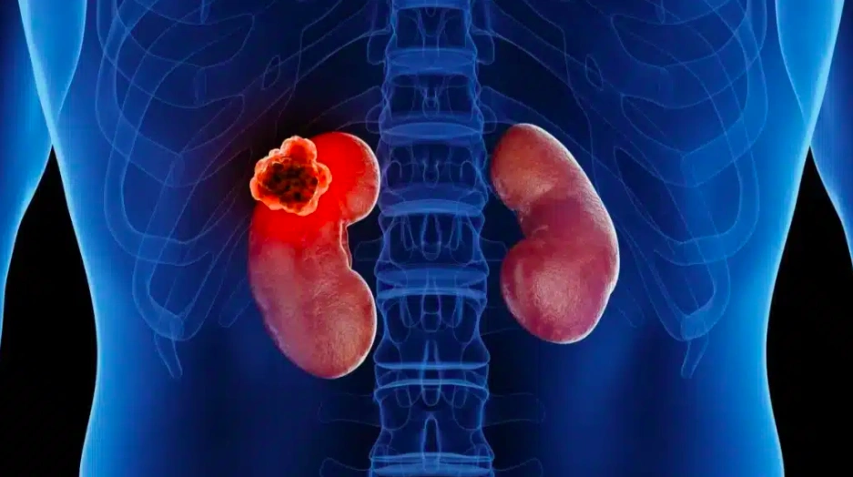 Ung thư thận - sát thủ thầm lặng - Báo VnExpress Sức khỏe