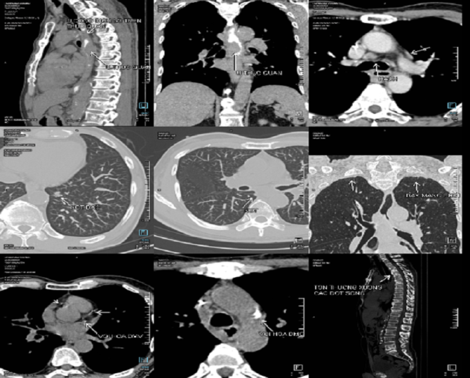 Phim chụp PET/CT của ông Hùng phát hiện ung thư thực quản lan rộng sang phổi. Ảnh: Bệnh viện Đa khoa Tâm Anh