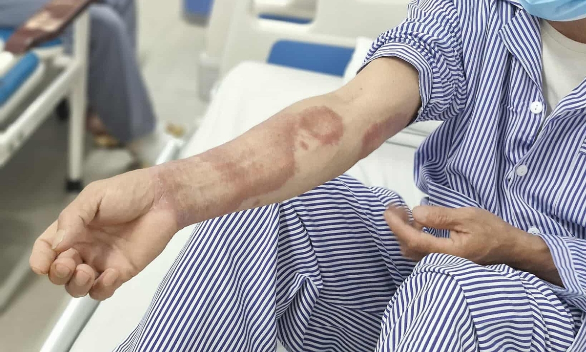 Bệnh phong âm thầm tấn công hai cha con