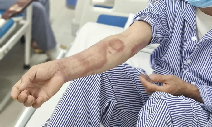 Tổn thương da ở bệnh nhân phong. Ảnh: Lê Nga