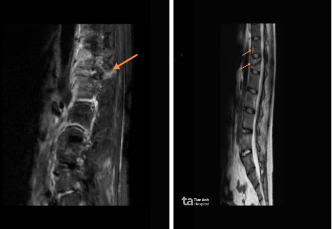 Chụp MRI cho thấy đốt sống ngực T12 của anh Thanh bị gãy xẹp. Ảnh: Bệnh viện Đa khoa Tâm Anh