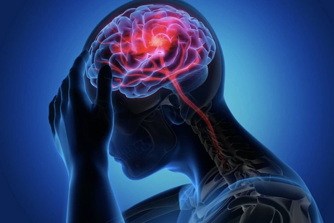 Minh họa một người bị đột quỵ tai biến mạch máu não. Ảnh: iStock