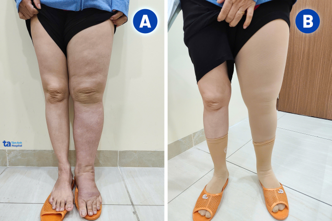 Chân trái bệnh nhân phù to (hình A) và sau khi đặt băng ép hai tuần (hình B). Ảnh: Hạ Vũ