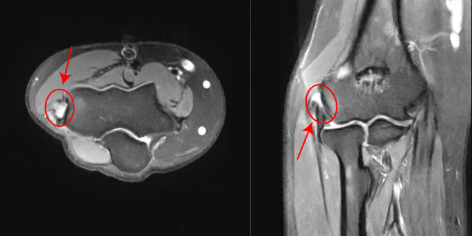 Kết quả chụp MRI của chị Thương cho thấy tổn thương đứt gân. Ảnh: Bệnh viện Đa khoa Tâm Anh