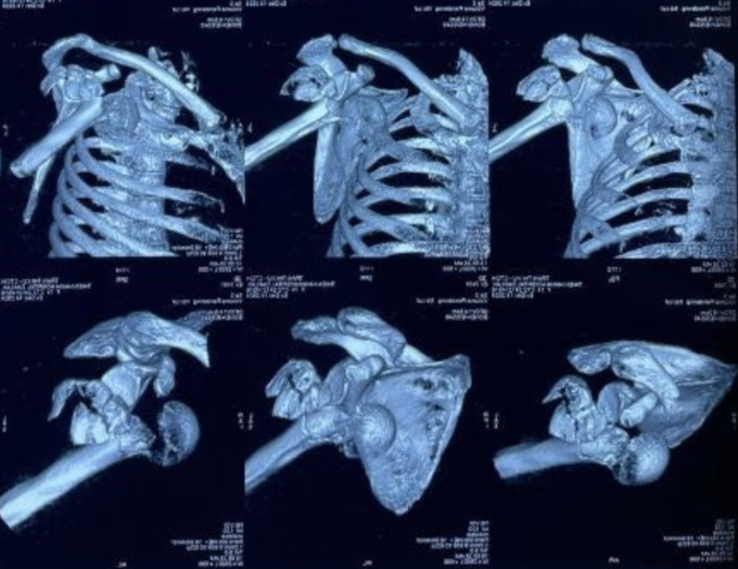 Ảnh CT cho thấy khớp vai phải (hàng trên) gãy thành nhiều mảnh, khớp vai trái gãy và trật. Ảnh: Bệnh viện Đa khoa Tâm Anh